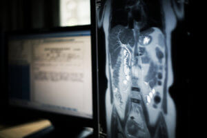 MRI showing Bile Duct Injury